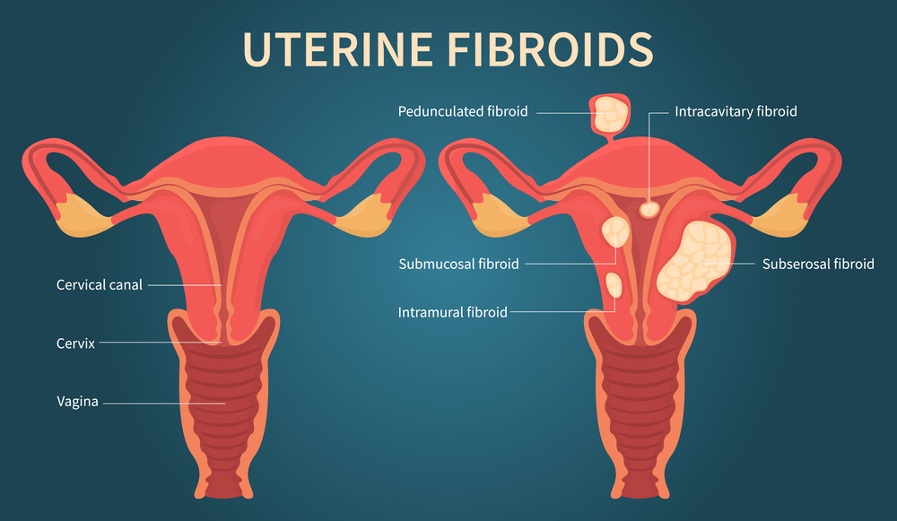 types of fibroids and location in uterus