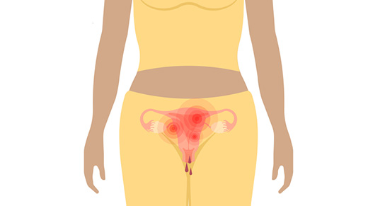 uterine inflammation