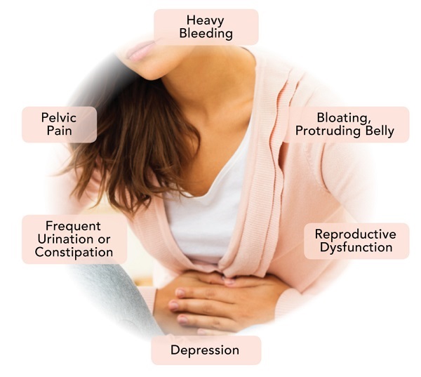 Symptoms of Uterine Fibroids